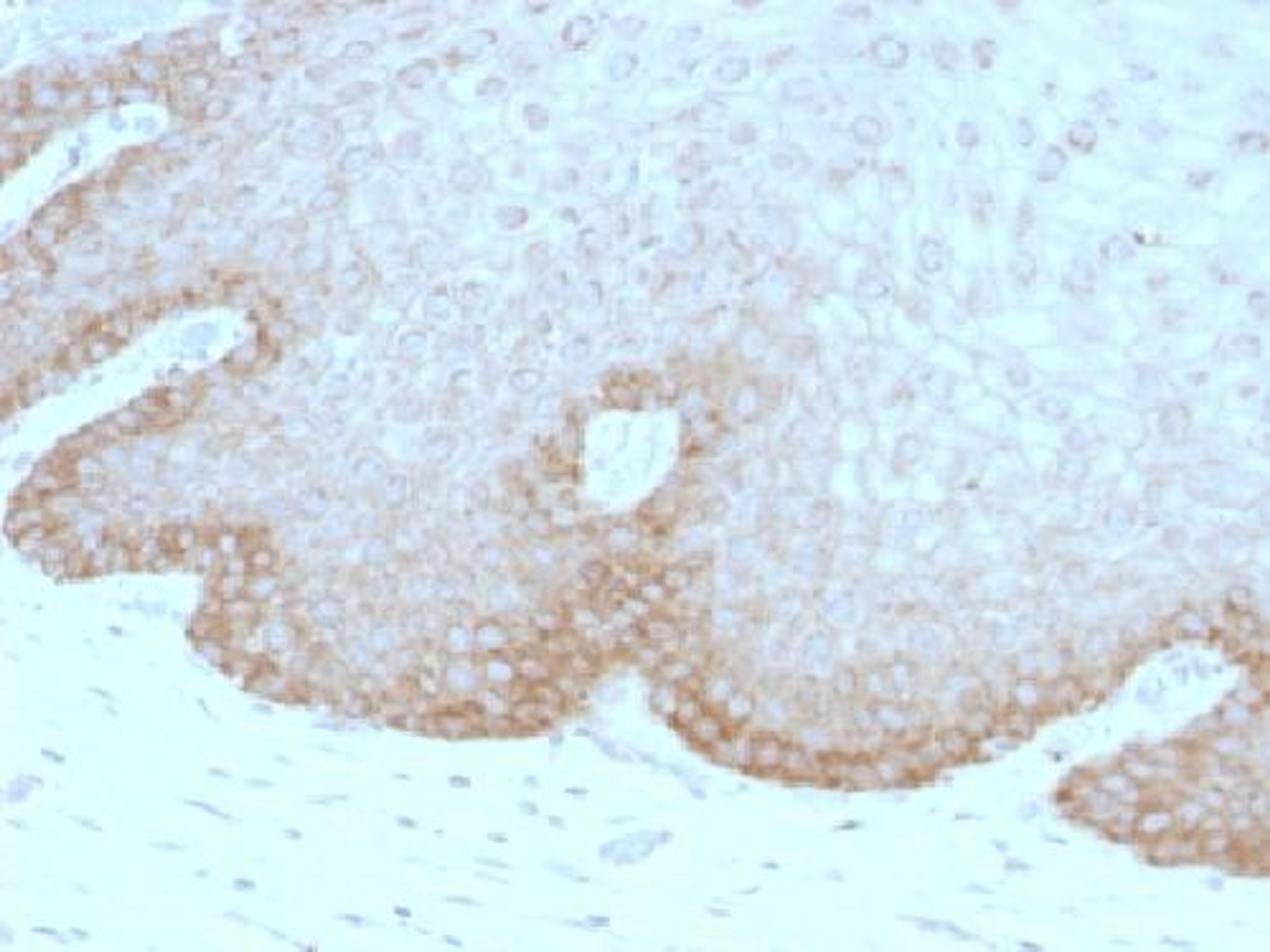 Immunohistochemical staining of human cervical carcinoma tissue using FAT2 antibody