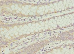 Immunohistochemistry of paraffin-embedded human colon cancer using CSB-PA892446DSR1HU at dilution of 1:100