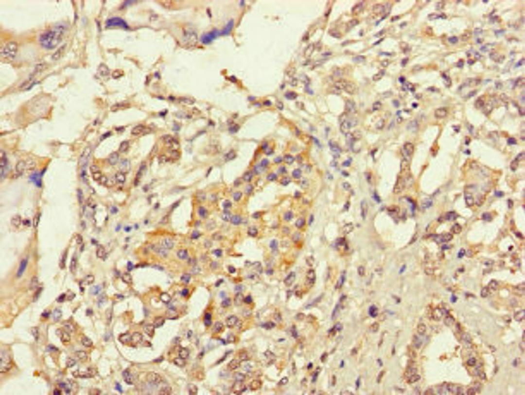 Immunohistochemistry of paraffin-embedded human pancreatic cancer using CSB-PA671121LA01HU at dilution of 1:100