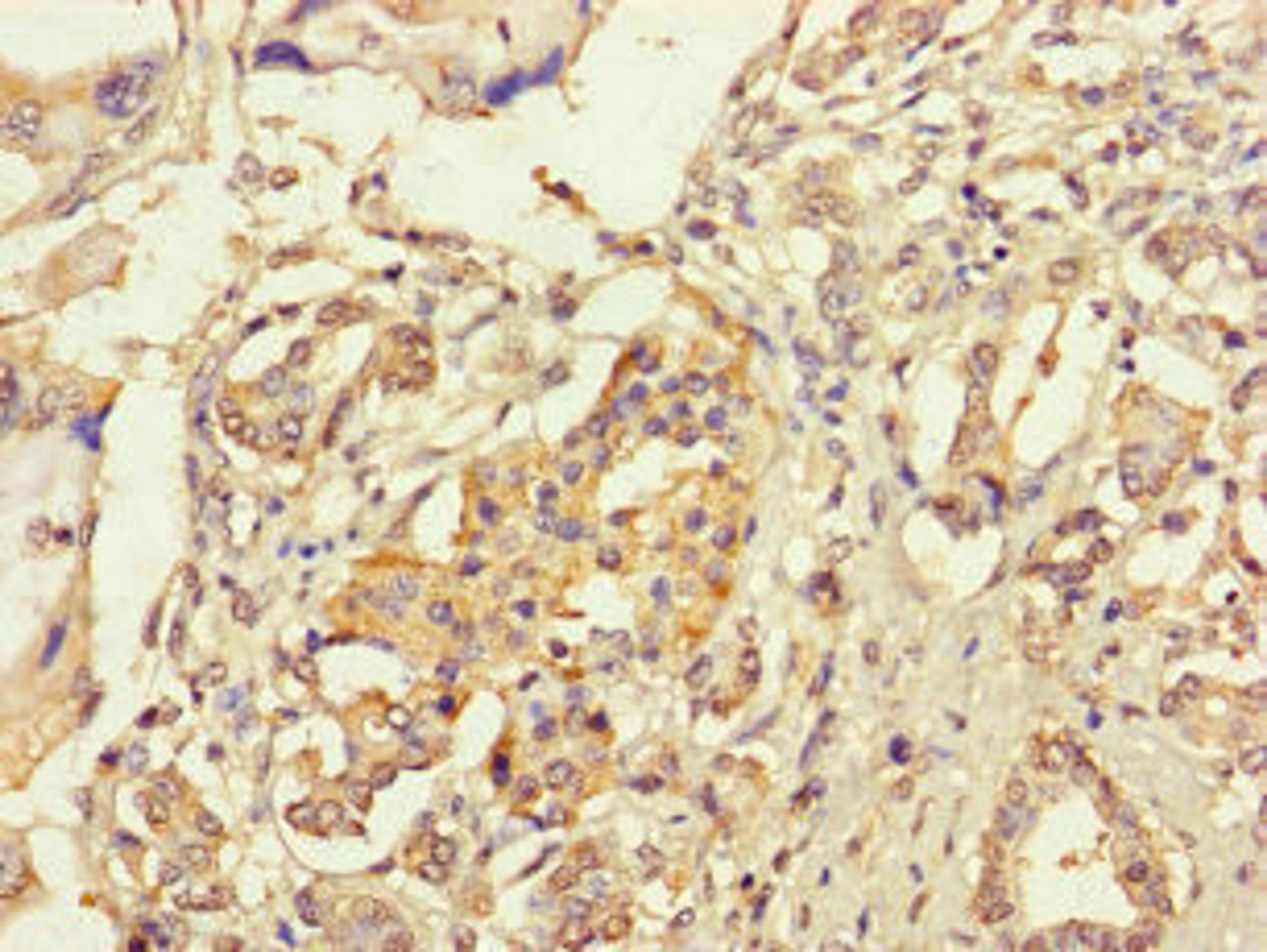 Immunohistochemistry of paraffin-embedded human pancreatic cancer using CSB-PA671121LA01HU at dilution of 1:100
