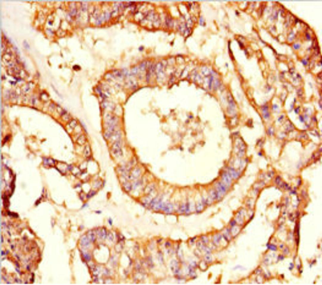 Immunohistochemistry of paraffin-embedded human endometrial cancer using CSB-PA878883LA01HU at dilution of 1:100