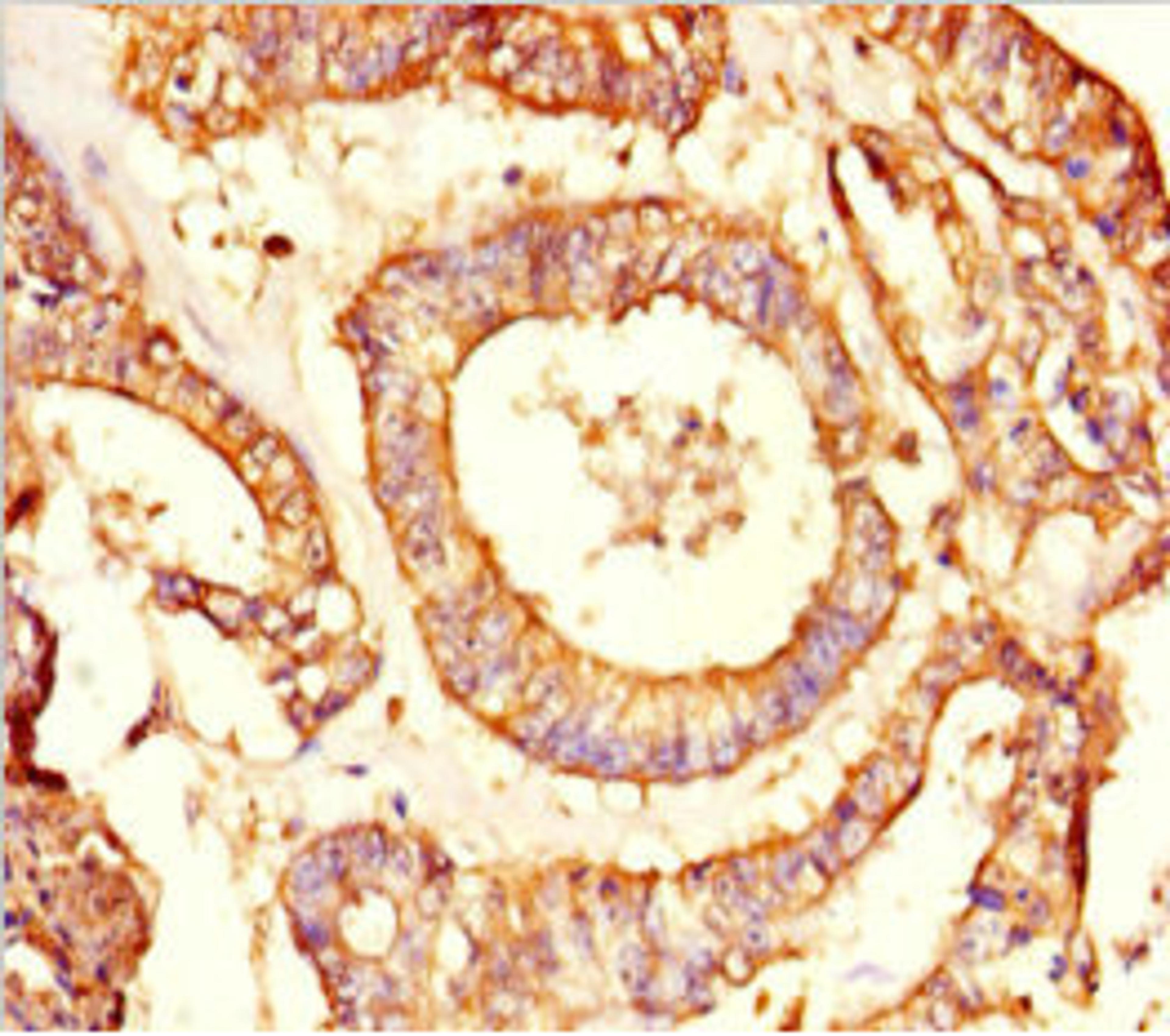 Immunohistochemistry of paraffin-embedded human endometrial cancer using CSB-PA878883LA01HU at dilution of 1:100
