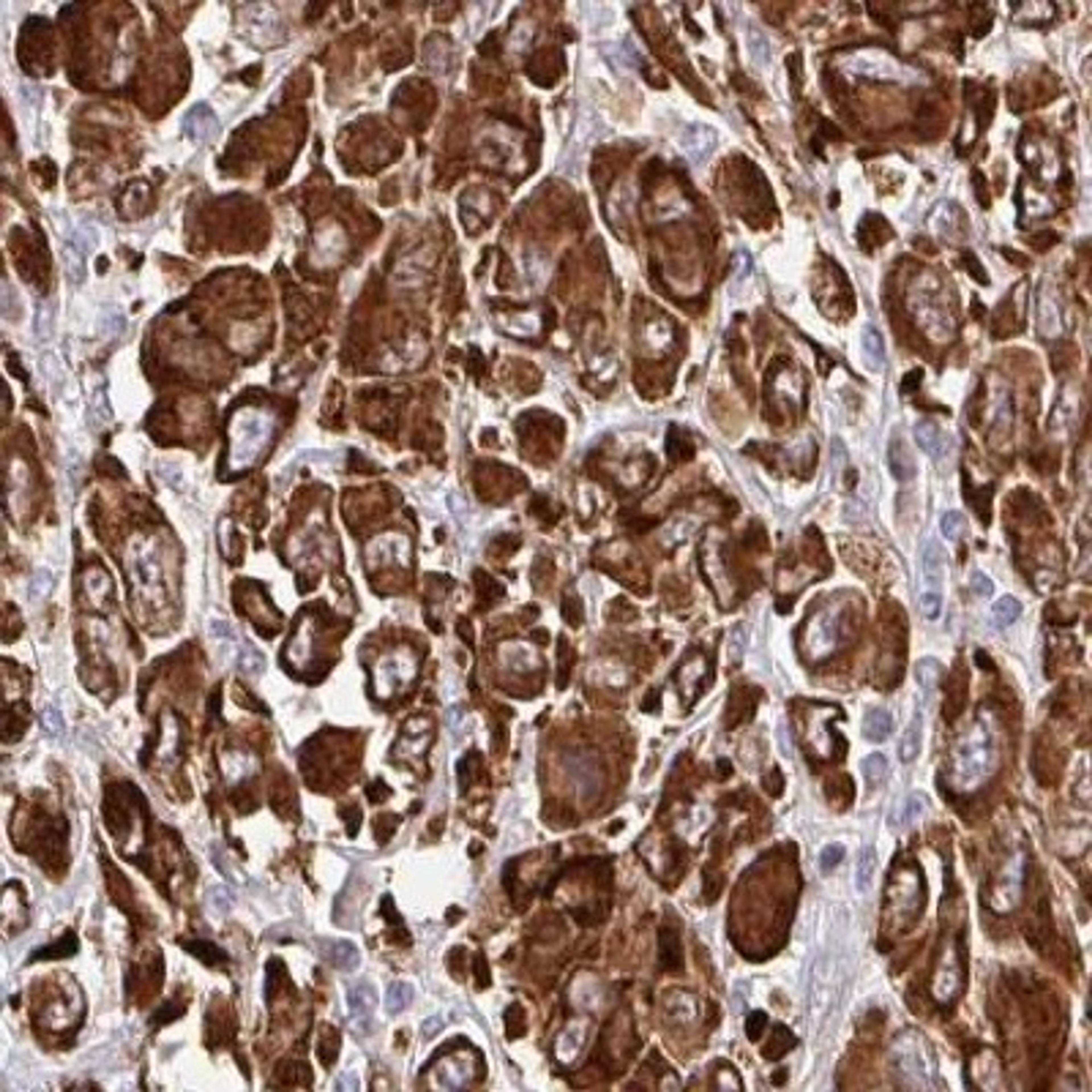 Immunohistochemistry: HPS1 Antibody [NBP2-31848] - melanoma