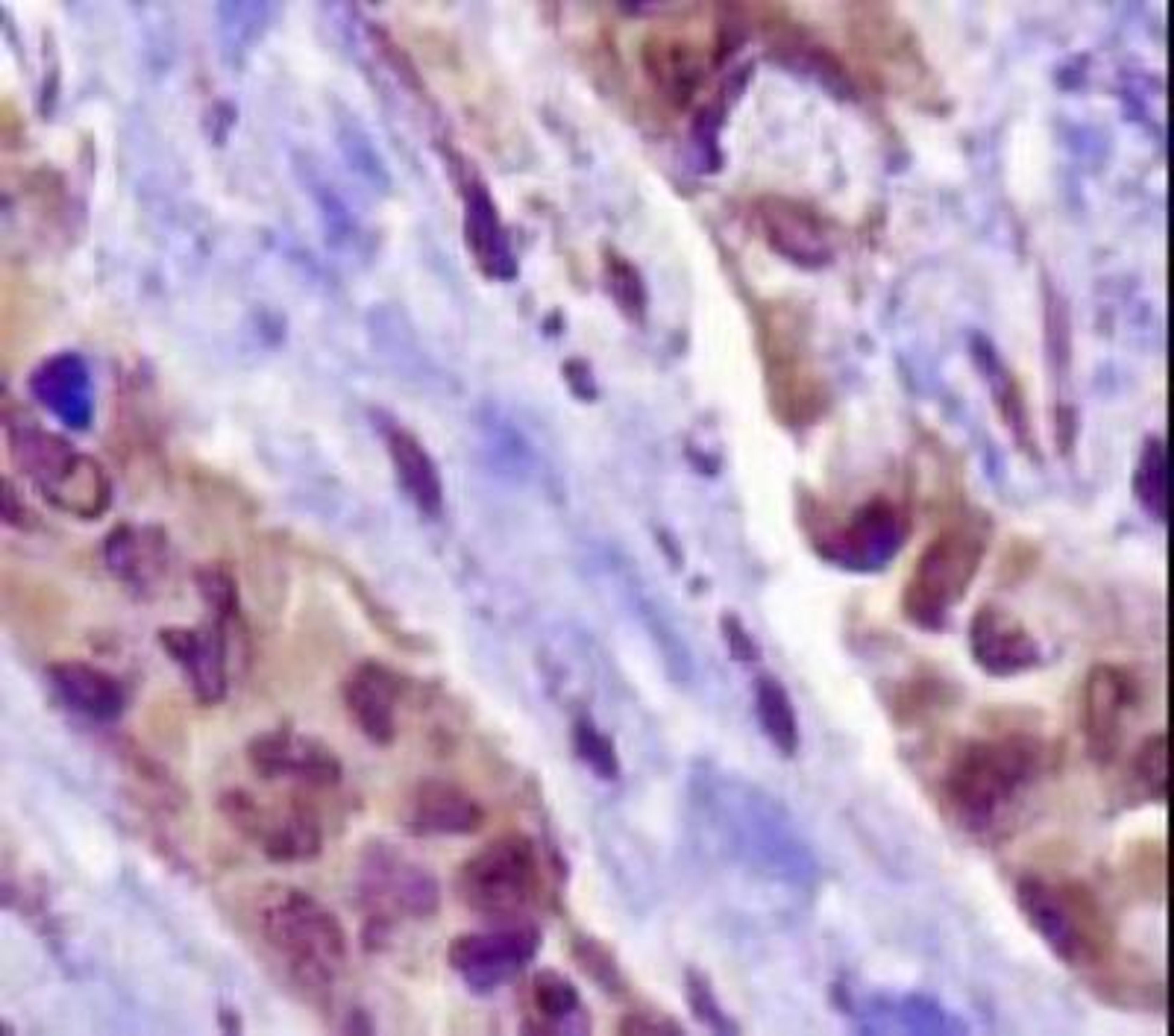 Immunohistochemistry-Paraffin: Napsin-A Antibody (TMU-Ad02) [NB110-68133] - Analysis of NAPSA on human lung adenocarcinoma using NB110-68133.