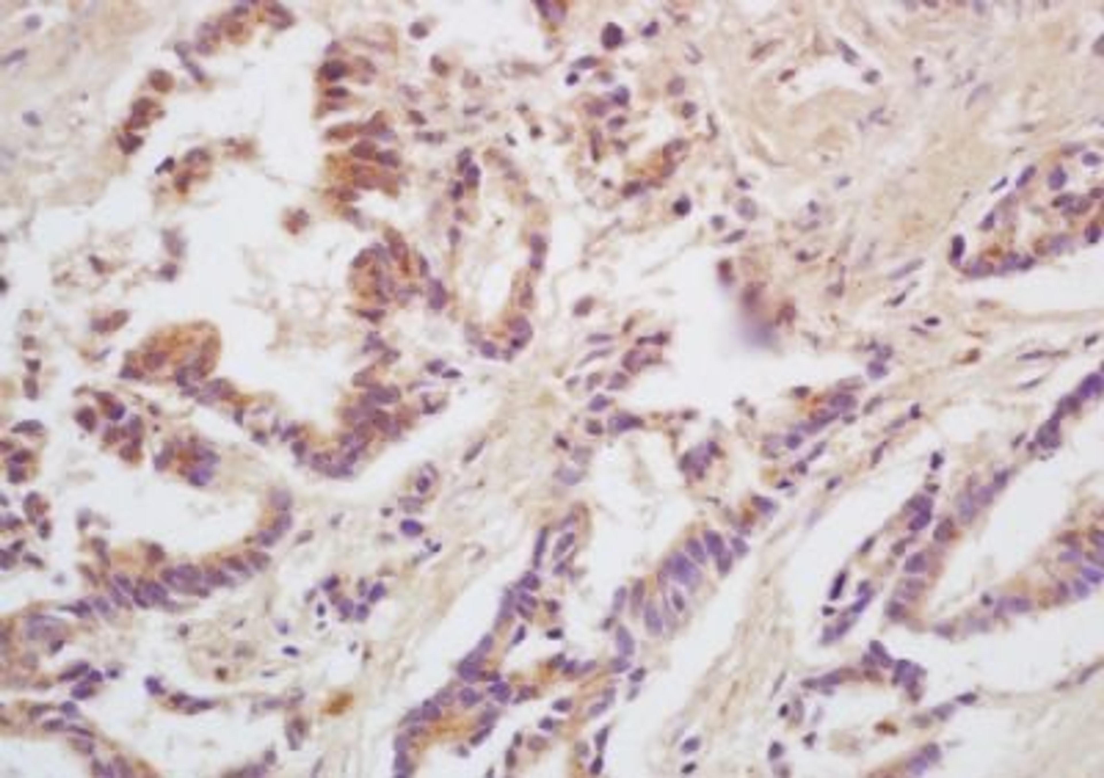 Immunohistochemical analysis of formalin-fixed paraffin embedded human gastric carcinoma tissue using FUT2 antibody (dilution at 1:200)