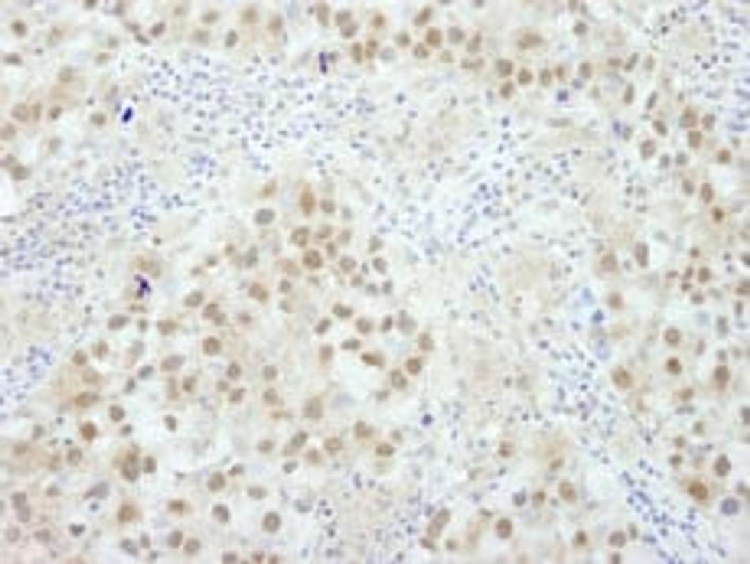 Detection of human BRCA1 by immunohistochemistry.