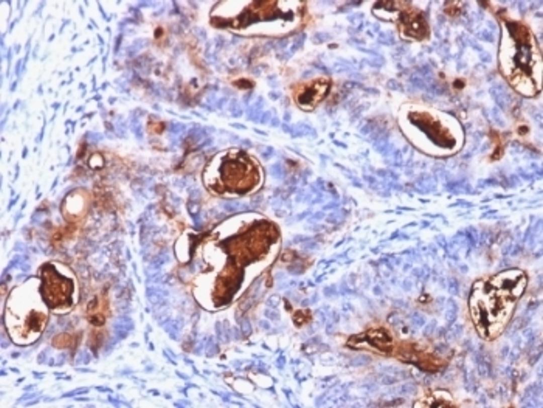 Formalin-fixed, paraffin-embedded human colon carcinoma stained with CEA antibody (C66/1260).