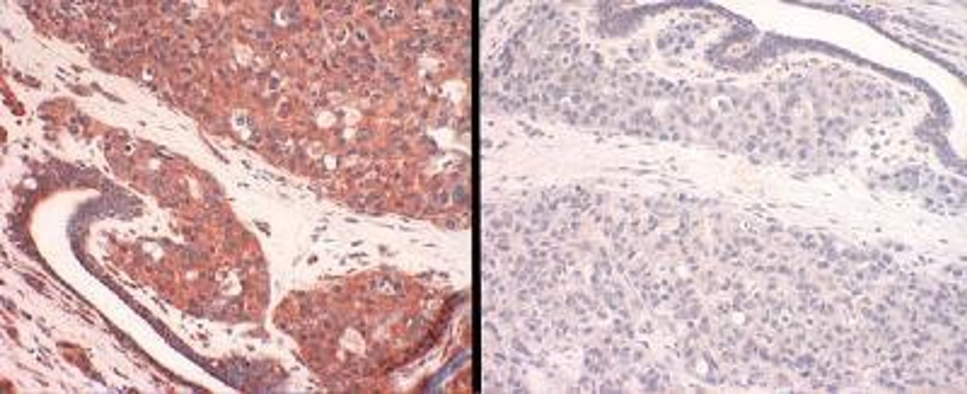 Immunohistochemistry: SLC31A1/CTR1 Antibody [NB100-402] - Panel 1: human CTR1 staining of breast cancer tissue. Panel 2: human CTR1-antigen competition in breast cancer tissue.