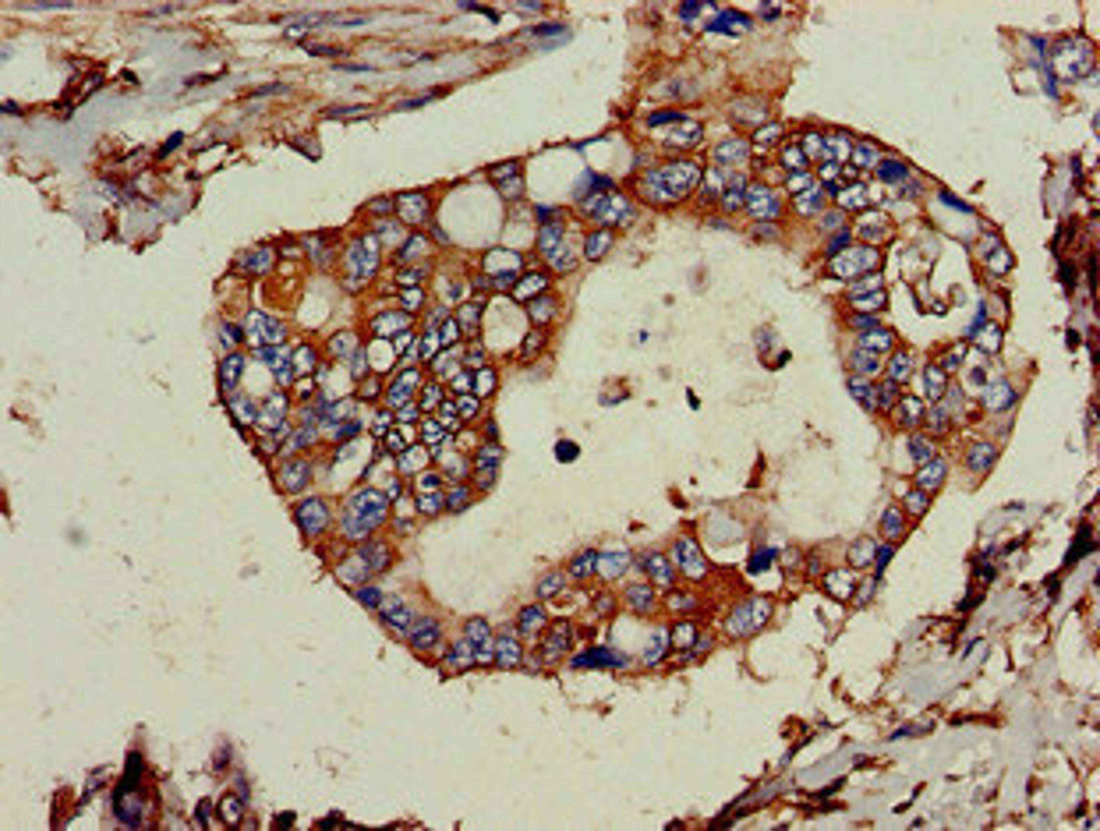Immunohistochemistry of paraffin-embedded human pancreatic cancer using CSB-PA024098LA01HU at dilution of 1:100