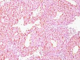 Immunohistochemical staining of human SC Lung Carcinoma tissue using CHGA antibody