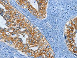 The image on the left is immunohistochemistry of paraffin-embedded Human cervical cancer tissue using CSB-PA042926(KRT81 Antibody) at dilution 1/15, on the right is treated with fusion protein. (Original magnification: ×200)