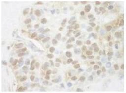 Immunohistochemistry-Paraffin: Pygopus-2 Antibody [NBP1-46171] - FFPE section of human breast carcinoma.   Antibody used at a dilution of 1:200 (1 ug/mg) Detection: DAB staining.