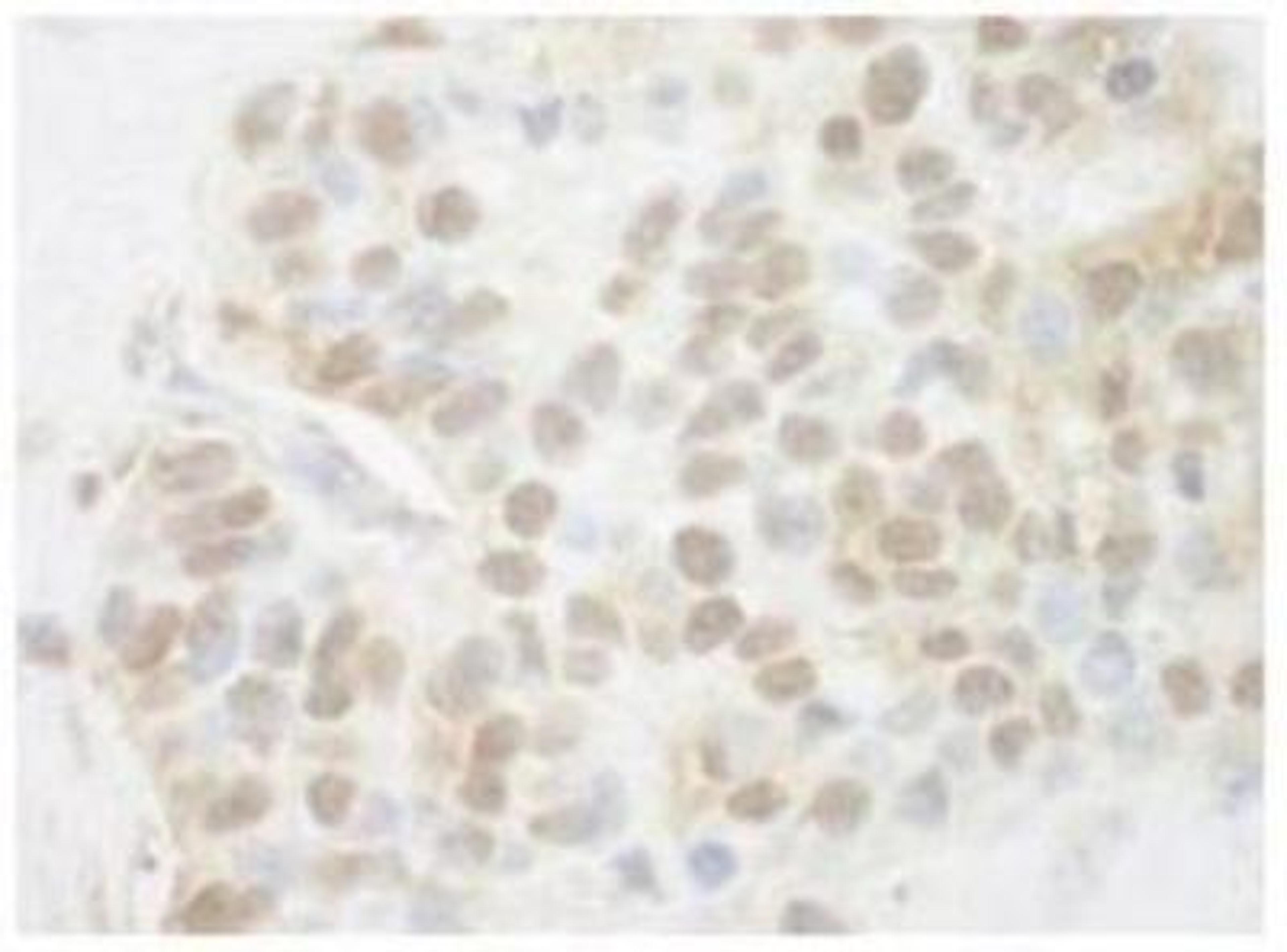 Immunohistochemistry-Paraffin: Pygopus-2 Antibody [NBP1-46171] - FFPE section of human breast carcinoma.   Antibody used at a dilution of 1:200 (1 ug/mg) Detection: DAB staining.