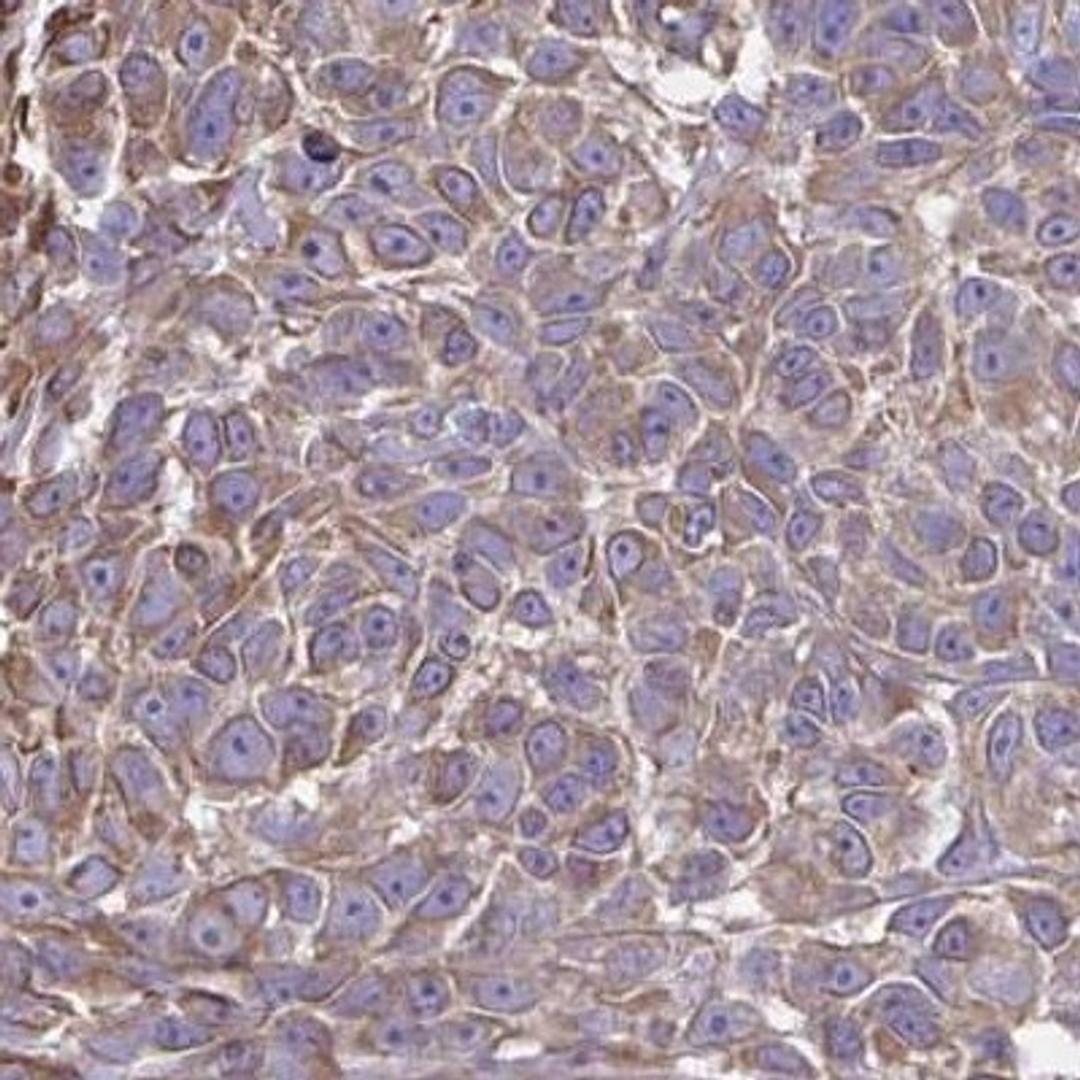 Immunohistochemistry: KF1 Antibody [NBP2-31700] - melanoma