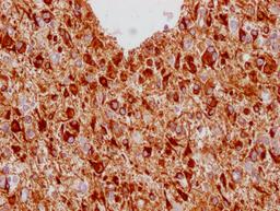 IHC image of CSB-MA293354 diluted at 1:100 and staining in paraffin-embedded human glioma cancer performed on a Leica BondTM system. After dewaxing and hydration, antigen retrieval was mediated by high pressure in a citrate buffer (pH 6.0). Section was blocked with 10% normal goat serum 30min at RT. Then primary antibody (1% BSA) was incubated at 4°C overnight. The primary is detected by a Goat anti-mouse IgG polymer labeled by HRP and visualized using 0.05% DAB.