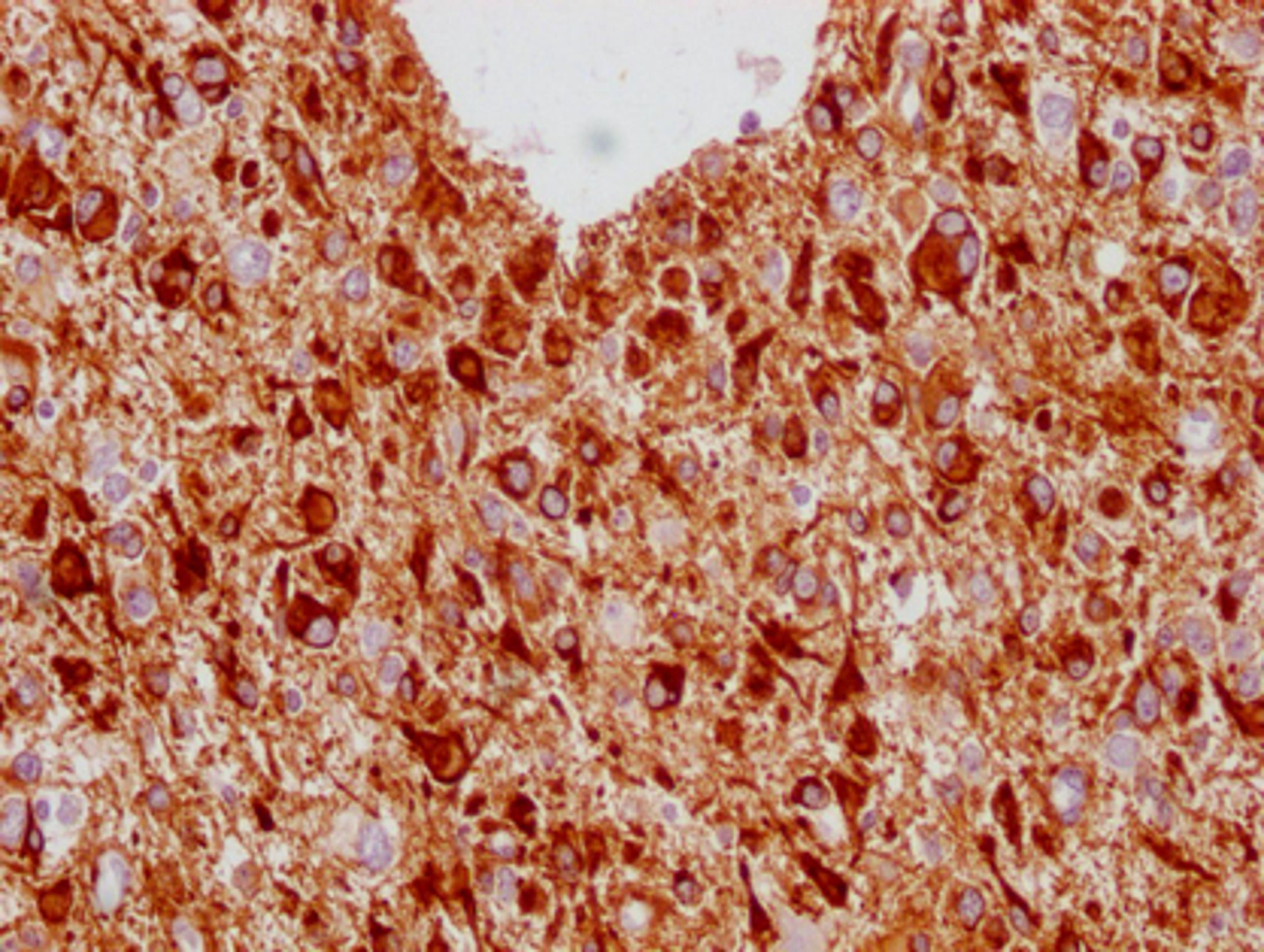 IHC image of CSB-MA293354 diluted at 1:100 and staining in paraffin-embedded human glioma cancer performed on a Leica BondTM system. After dewaxing and hydration, antigen retrieval was mediated by high pressure in a citrate buffer (pH 6.0). Section was blocked with 10% normal goat serum 30min at RT. Then primary antibody (1% BSA) was incubated at 4°C overnight. The primary is detected by a Goat anti-mouse IgG polymer labeled by HRP and visualized using 0.05% DAB.