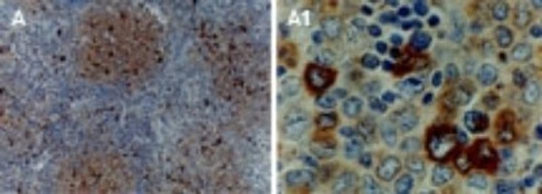 Immunohistochemistry-Paraffin: TRADD Antibody [NB100-56169] - Formalin-fixed, paraffin-embedded human lymphoma tissue section stained for TRAF1 expression using NB100-56170 at 1:2000. Hematoxylin-eosin counterstain.  A1 is a higher magnification of A.