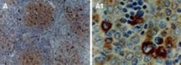 Immunohistochemistry-Paraffin: TRADD Antibody [NB100-56169] - Formalin-fixed, paraffin-embedded human lymphoma tissue section stained for TRAF1 expression using NB100-56170 at 1:2000. Hematoxylin-eosin counterstain.  A1 is a higher magnification of A.