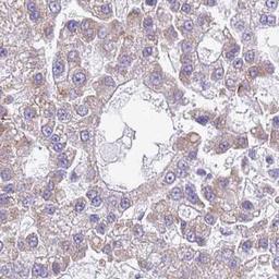 Immunohistochemistry: OAZ2 Antibody [NBP2-32056] - liver cancer