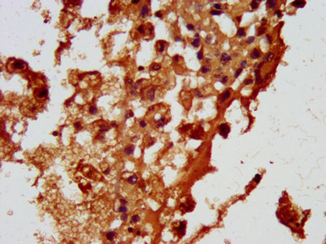 IHC image of CSB-PA857429LA01HU diluted at 1:100 and staining in paraffin-embedded human melanoma performed on a Leica BondTM system. After dewaxing and hydration, antigen retrieval was mediated by high pressure in a citrate buffer (pH 6.0). Section was blocked with 10% normal goat serum 30min at RT. Then primary antibody (1% BSA) was incubated at 4°C overnight. The primary is detected by a biotinylated secondary antibody and visualized using an HRP conjugated SP system.