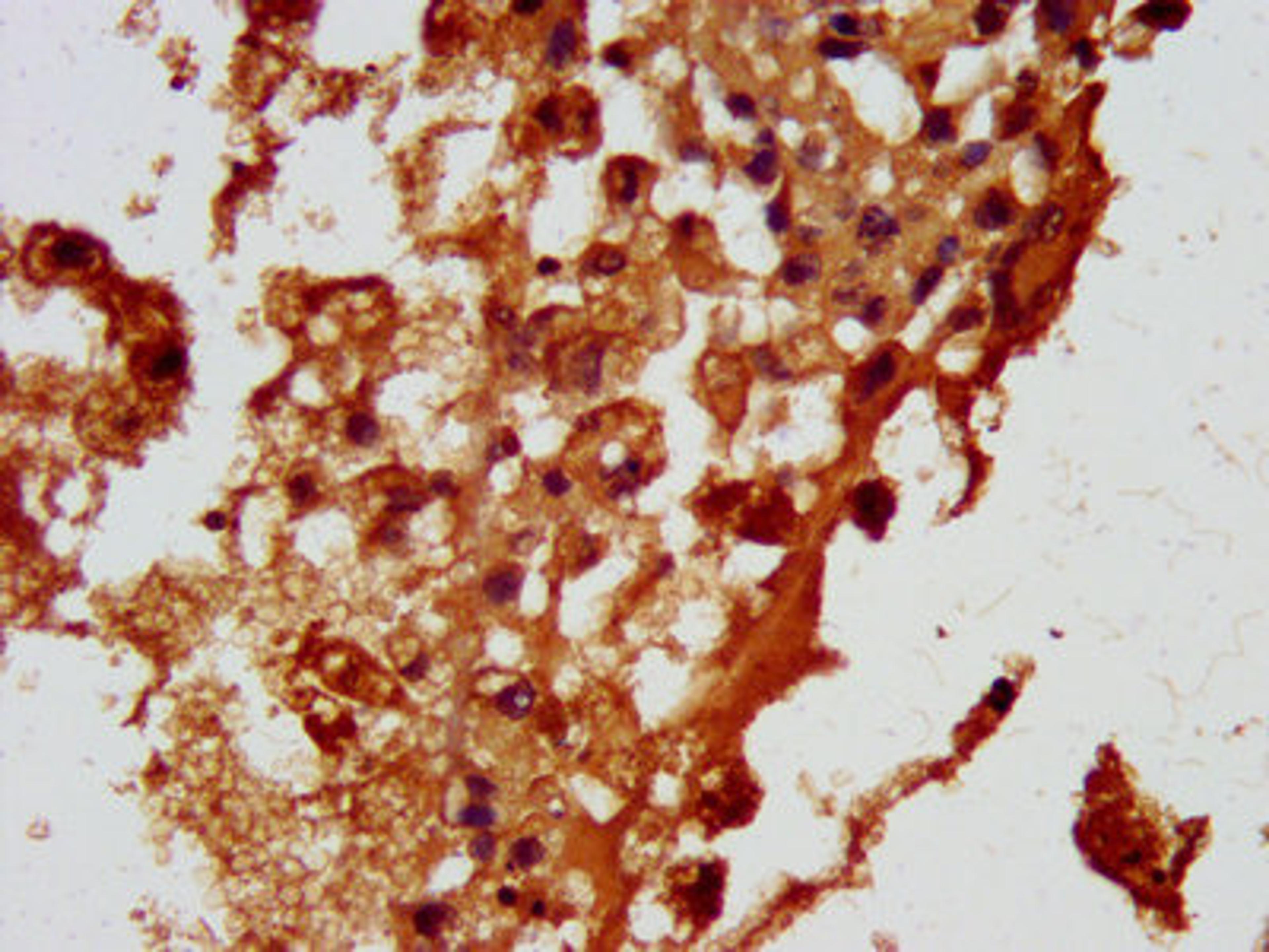 IHC image of CSB-PA857429LA01HU diluted at 1:100 and staining in paraffin-embedded human melanoma performed on a Leica BondTM system. After dewaxing and hydration, antigen retrieval was mediated by high pressure in a citrate buffer (pH 6.0). Section was blocked with 10% normal goat serum 30min at RT. Then primary antibody (1% BSA) was incubated at 4°C overnight. The primary is detected by a biotinylated secondary antibody and visualized using an HRP conjugated SP system.