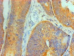 Immunohistochemical of paraffin-embedded Human Colon cancer tissue using CSB-MA8378691A0m at dilution of 1:200.