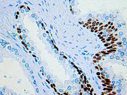 Immunohistochemical staining of Prostate basal cell nuclei stained using p63 Protein antibody