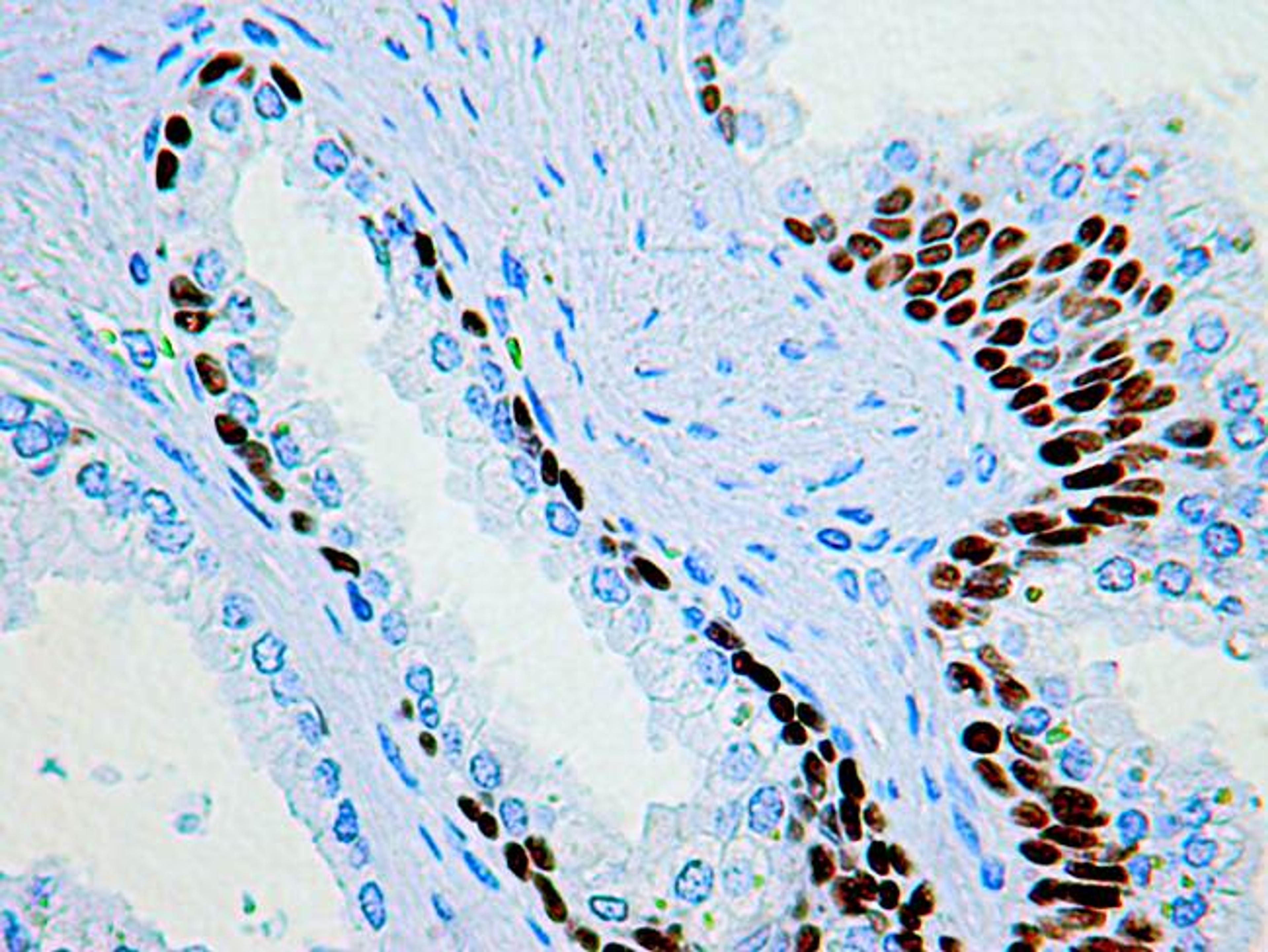 Immunohistochemical staining of Prostate basal cell nuclei stained using p63 Protein antibody