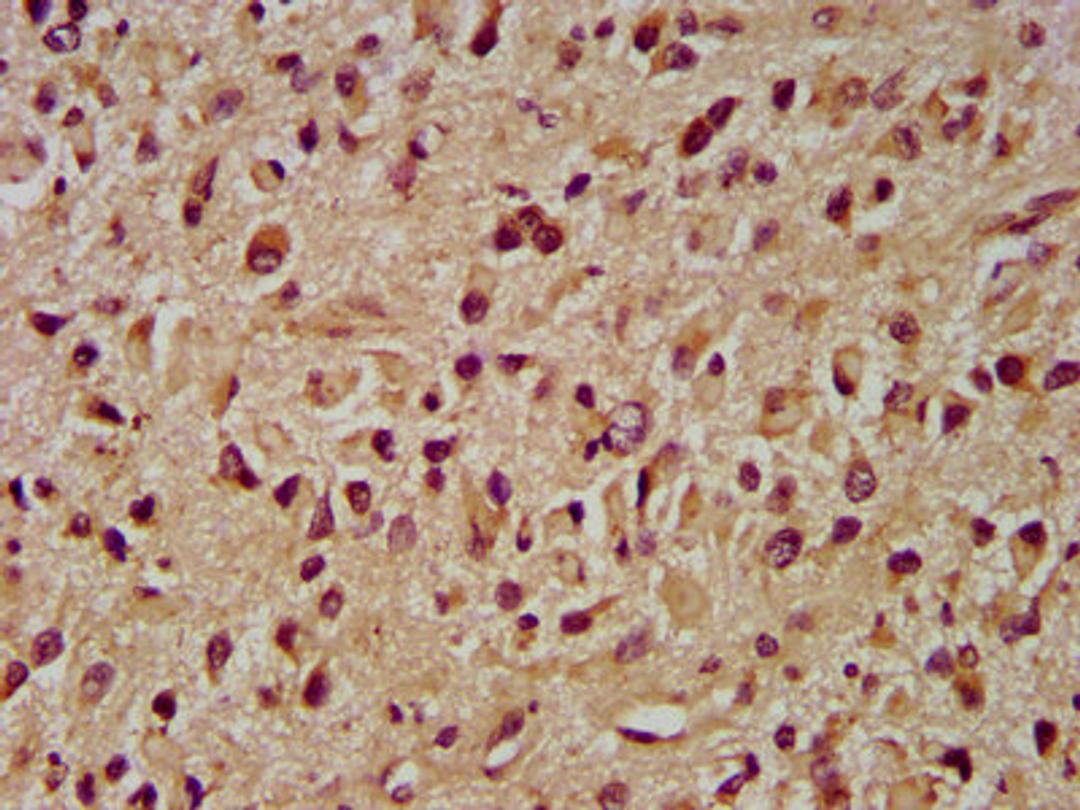 IHC image of CSB-PA011734LA01HU diluted at 1:400 and staining in paraffin-embedded human glioma performed on a Leica BondTM system. After dewaxing and hydration, antigen retrieval was mediated by high pressure in a citrate buffer (pH 6.0). Section was blocked with 10% normal goat serum 30min at RT. Then primary antibody (1% BSA) was incubated at 4&deg;C overnight. The primary is detected by a biotinylated secondary antibody and visualized using an HRP conjugated SP system.