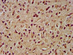IHC image of CSB-PA011734LA01HU diluted at 1:400 and staining in paraffin-embedded human glioma performed on a Leica BondTM system. After dewaxing and hydration, antigen retrieval was mediated by high pressure in a citrate buffer (pH 6.0). Section was blocked with 10% normal goat serum 30min at RT. Then primary antibody (1% BSA) was incubated at 4&deg;C overnight. The primary is detected by a biotinylated secondary antibody and visualized using an HRP conjugated SP system.