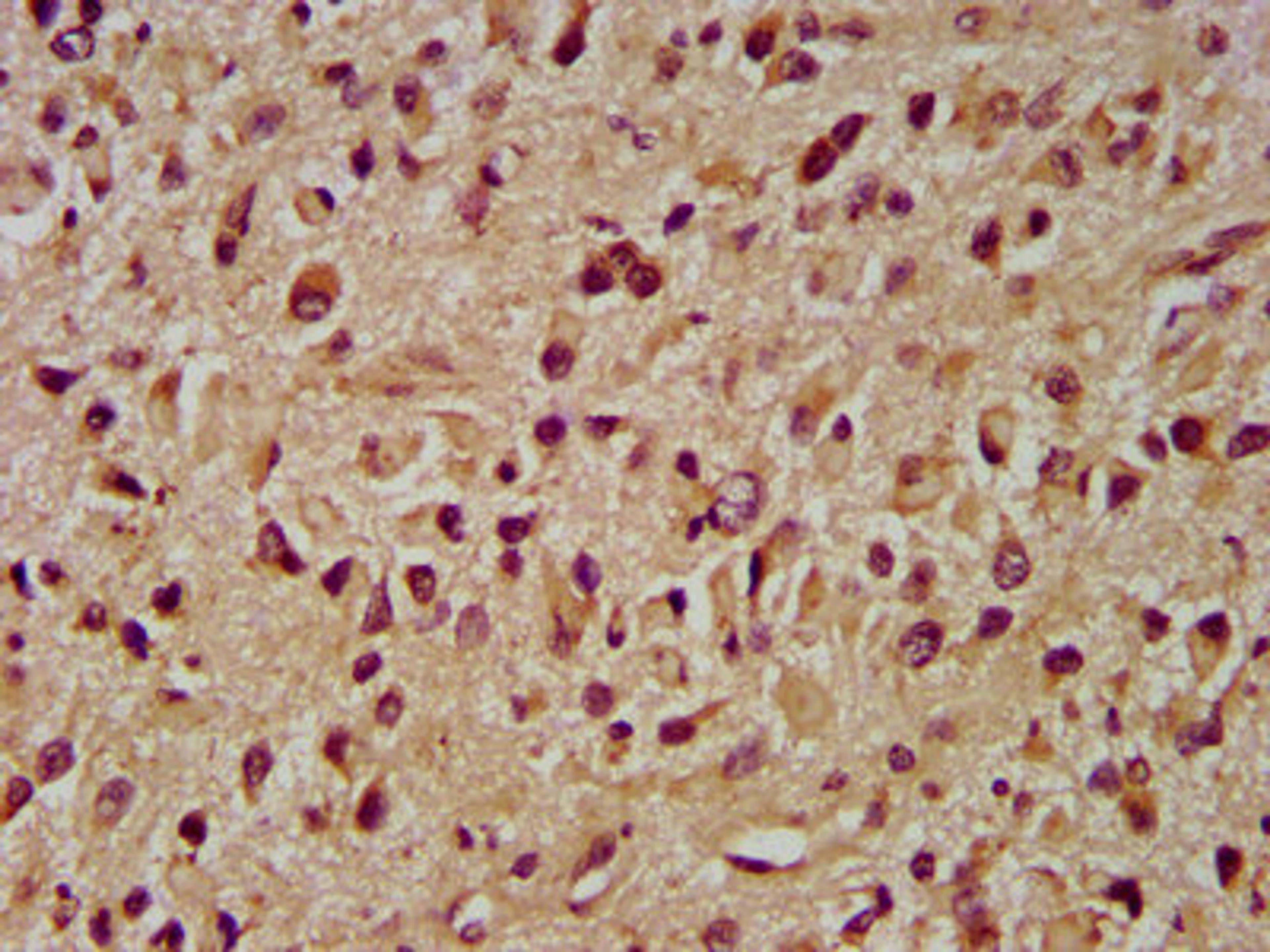 IHC image of CSB-PA011734LA01HU diluted at 1:400 and staining in paraffin-embedded human glioma performed on a Leica BondTM system. After dewaxing and hydration, antigen retrieval was mediated by high pressure in a citrate buffer (pH 6.0). Section was blocked with 10% normal goat serum 30min at RT. Then primary antibody (1% BSA) was incubated at 4&deg;C overnight. The primary is detected by a biotinylated secondary antibody and visualized using an HRP conjugated SP system.