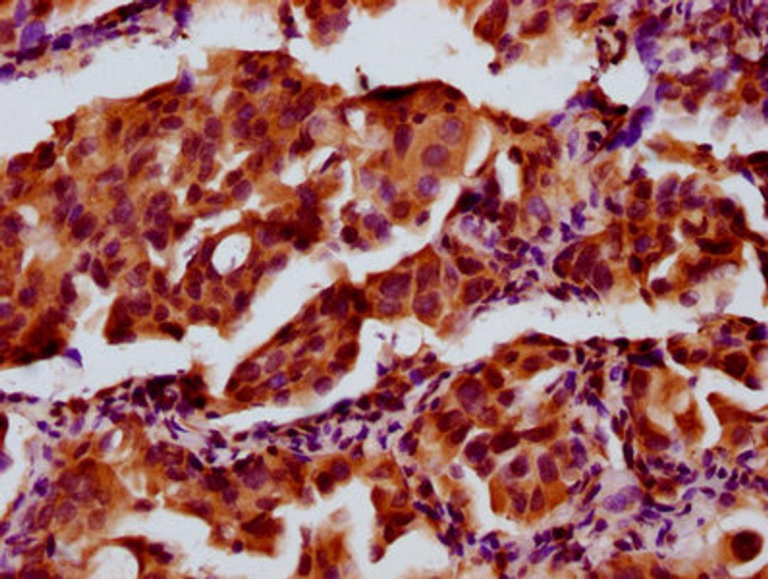 IHC image of CSB-PA814205LA01HU diluted at 1:300 and staining in paraffin-embedded human lung cancer performed on a Leica BondTM system. After dewaxing and hydration, antigen retrieval was mediated by high pressure in a citrate buffer (pH 6.0). Section was blocked with 10% normal goat serum 30min at RT. Then primary antibody (1% BSA) was incubated at 4&deg;C overnight. The primary is detected by a biotinylated secondary antibody and visualized using an HRP conjugated SP system.