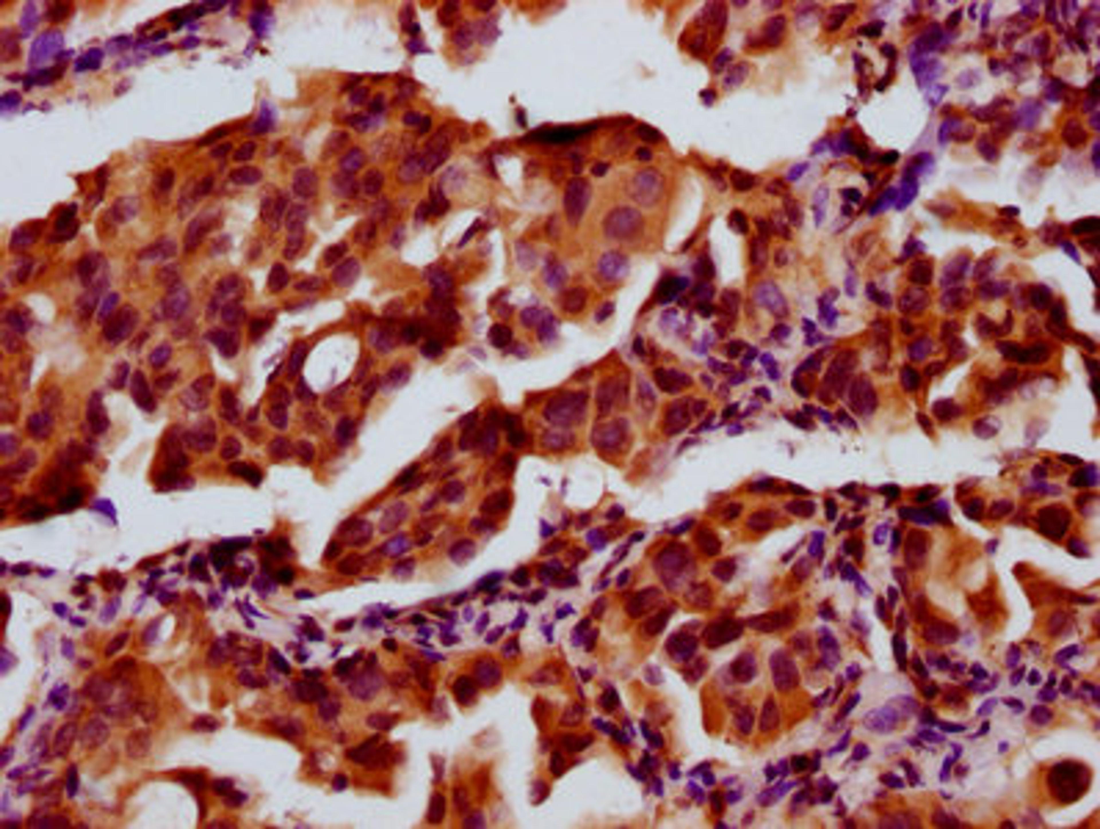IHC image of CSB-PA814205LA01HU diluted at 1:300 and staining in paraffin-embedded human lung cancer performed on a Leica BondTM system. After dewaxing and hydration, antigen retrieval was mediated by high pressure in a citrate buffer (pH 6.0). Section was blocked with 10% normal goat serum 30min at RT. Then primary antibody (1% BSA) was incubated at 4&deg;C overnight. The primary is detected by a biotinylated secondary antibody and visualized using an HRP conjugated SP system.