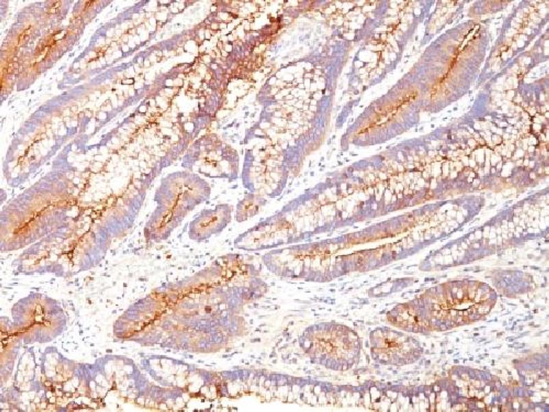 Immunohistochemical staining of human Colon Carcinoma tissue using CD66 antibody