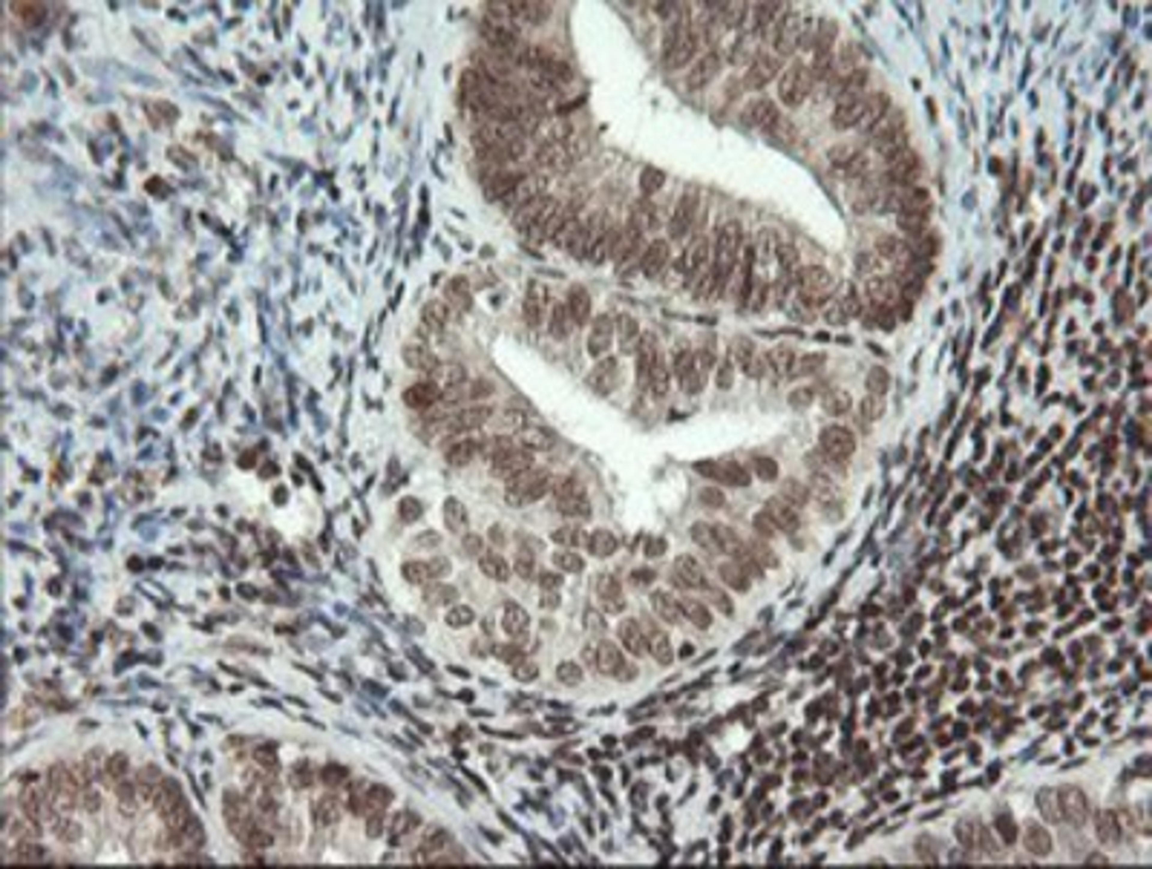 Immunohistochemistry-Paraffin: MCT1 Antibody (2F9) [NBP2-03626] - Staining of paraffin-embedded Adenocarcinoma of Human endometrium tissue using anti-MCT1 mouse monoclonal antibody.