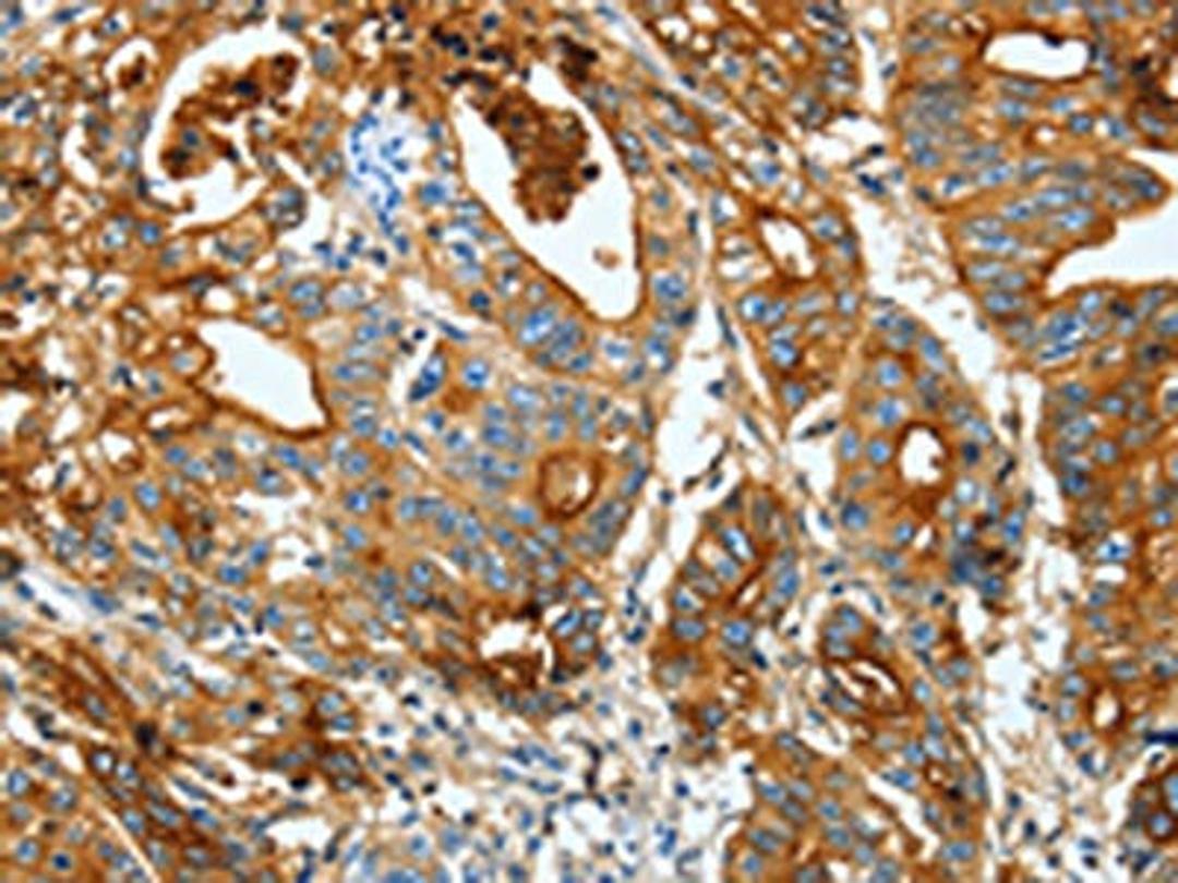 The image on the left is immunohistochemistry of paraffin-embedded Human gastic cancer tissue using CSB-PA229032(CEACAM5 Antibody) at dilution 1/20, on the right is treated with fusion protein. (Original magnification: ×200)