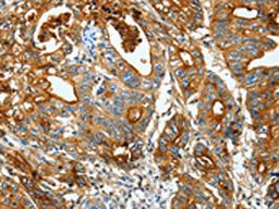 The image on the left is immunohistochemistry of paraffin-embedded Human gastic cancer tissue using CSB-PA229032(CEACAM5 Antibody) at dilution 1/20, on the right is treated with fusion protein. (Original magnification: ×200)
