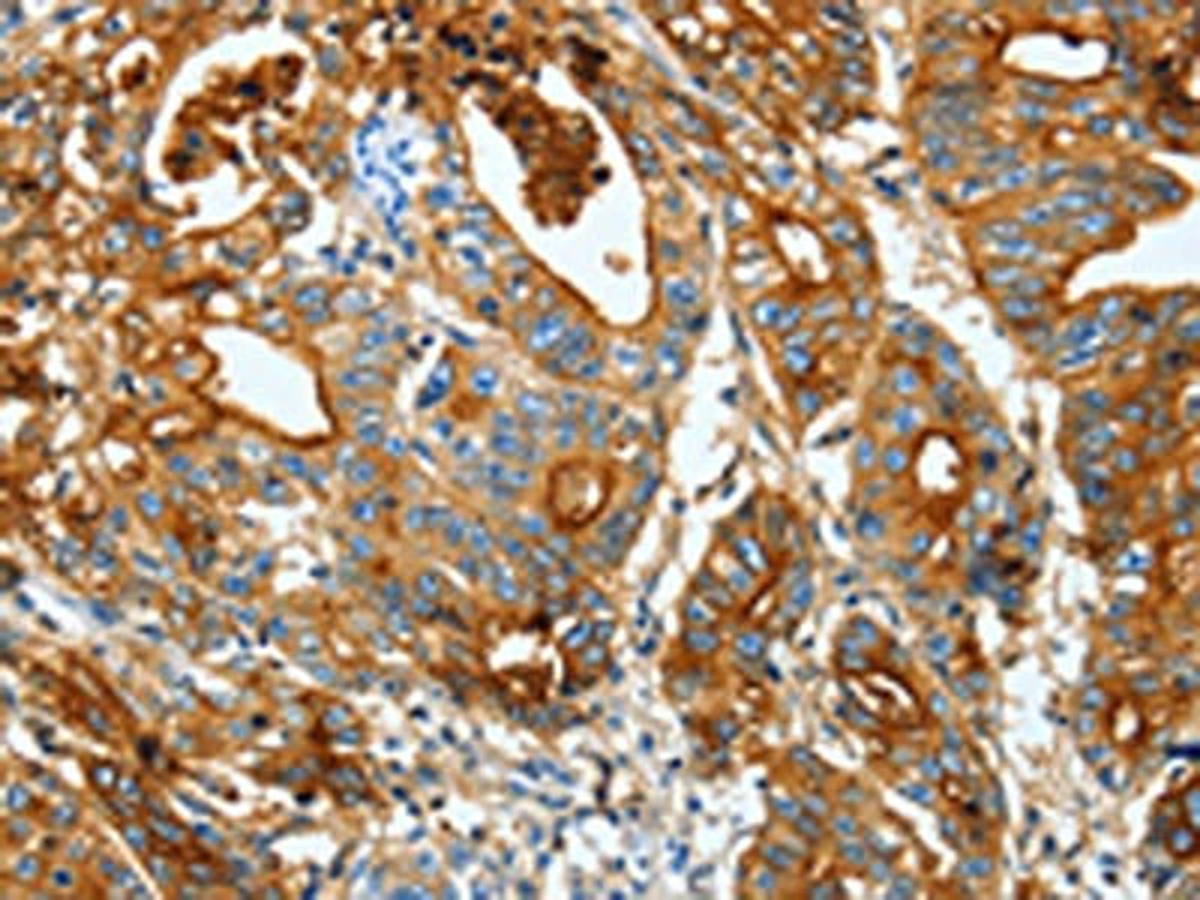 The image on the left is immunohistochemistry of paraffin-embedded Human gastic cancer tissue using CSB-PA229032(CEACAM5 Antibody) at dilution 1/20, on the right is treated with fusion protein. (Original magnification: ×200)