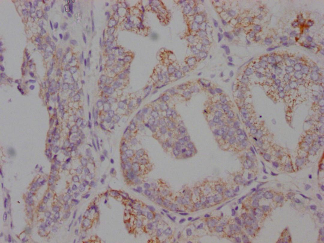 IHC image of CSB-MA546610 diluted at 1:100 and staining in paraffin-embedded human prostate cancer performed on a Leica BondTM system. After dewaxing and hydration, antigen retrieval was mediated by high pressure in a citrate buffer (pH 6.0). Section was blocked with 10% normal goat serum 30min at RT. Then primary antibody (1% BSA) was incubated at 4°C overnight. The primary is detected by a Goat anti-mouse IgG polymer labeled by HRP and visualized using 0.05% DAB.