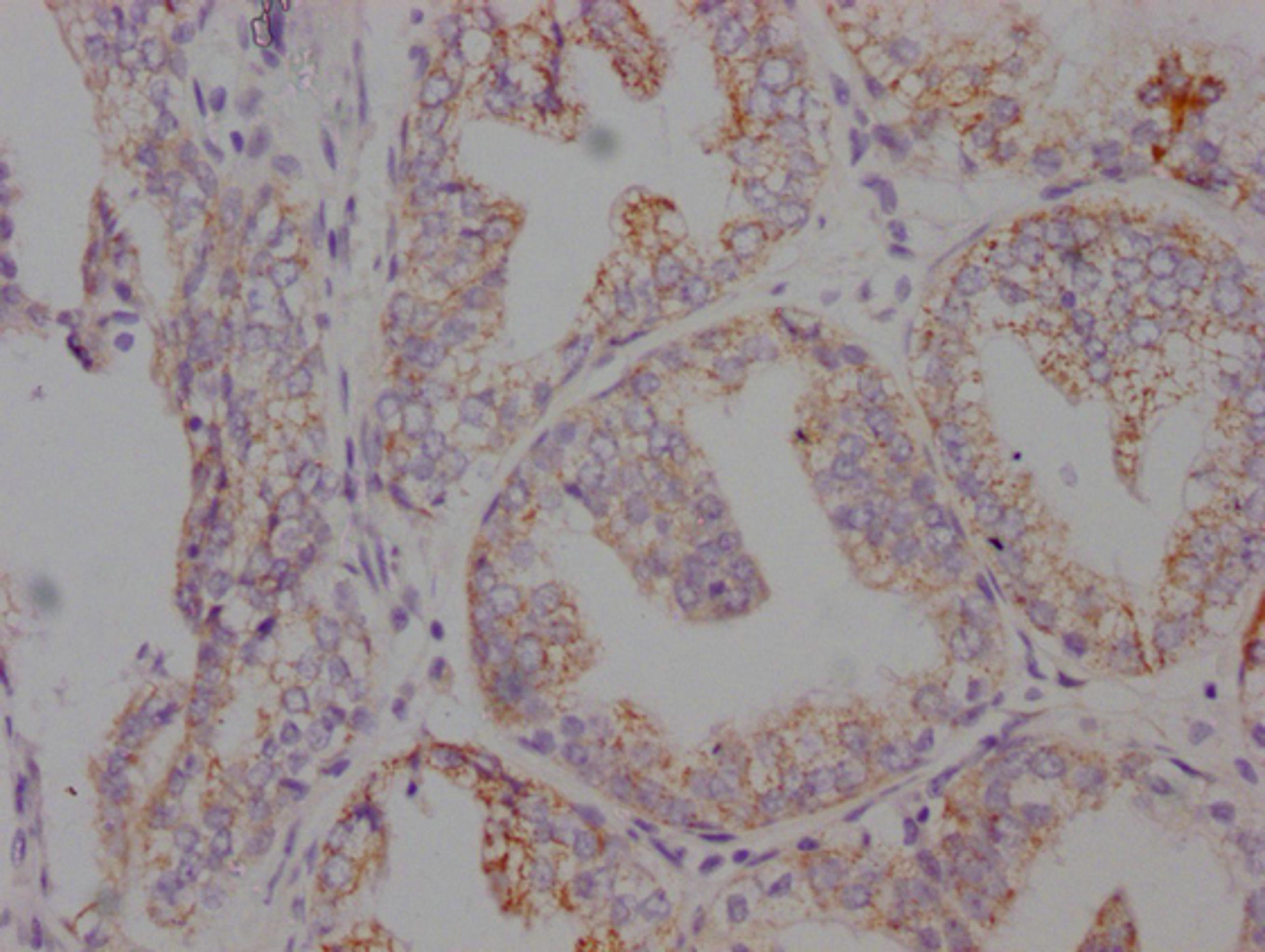 IHC image of CSB-MA546610 diluted at 1:100 and staining in paraffin-embedded human prostate cancer performed on a Leica BondTM system. After dewaxing and hydration, antigen retrieval was mediated by high pressure in a citrate buffer (pH 6.0). Section was blocked with 10% normal goat serum 30min at RT. Then primary antibody (1% BSA) was incubated at 4°C overnight. The primary is detected by a Goat anti-mouse IgG polymer labeled by HRP and visualized using 0.05% DAB.
