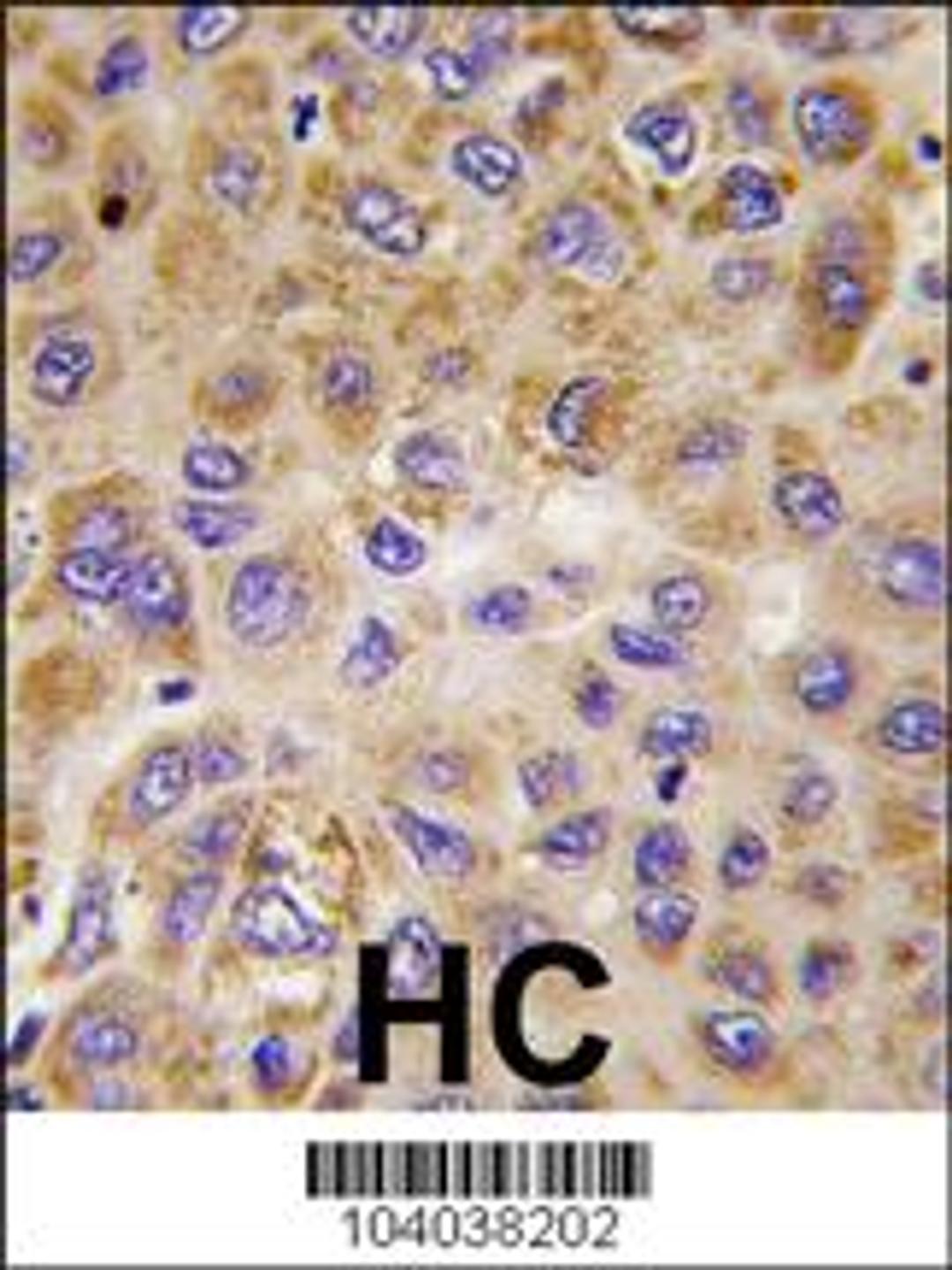 Formalin-fixed and paraffin-embedded human hepatocarcinoma tissue reacted with PFKFB1 antibody , which was peroxidase-conjugated to the secondary antibody, followed by DAB staining.