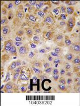 Formalin-fixed and paraffin-embedded human hepatocarcinoma tissue reacted with PFKFB1 antibody , which was peroxidase-conjugated to the secondary antibody, followed by DAB staining.