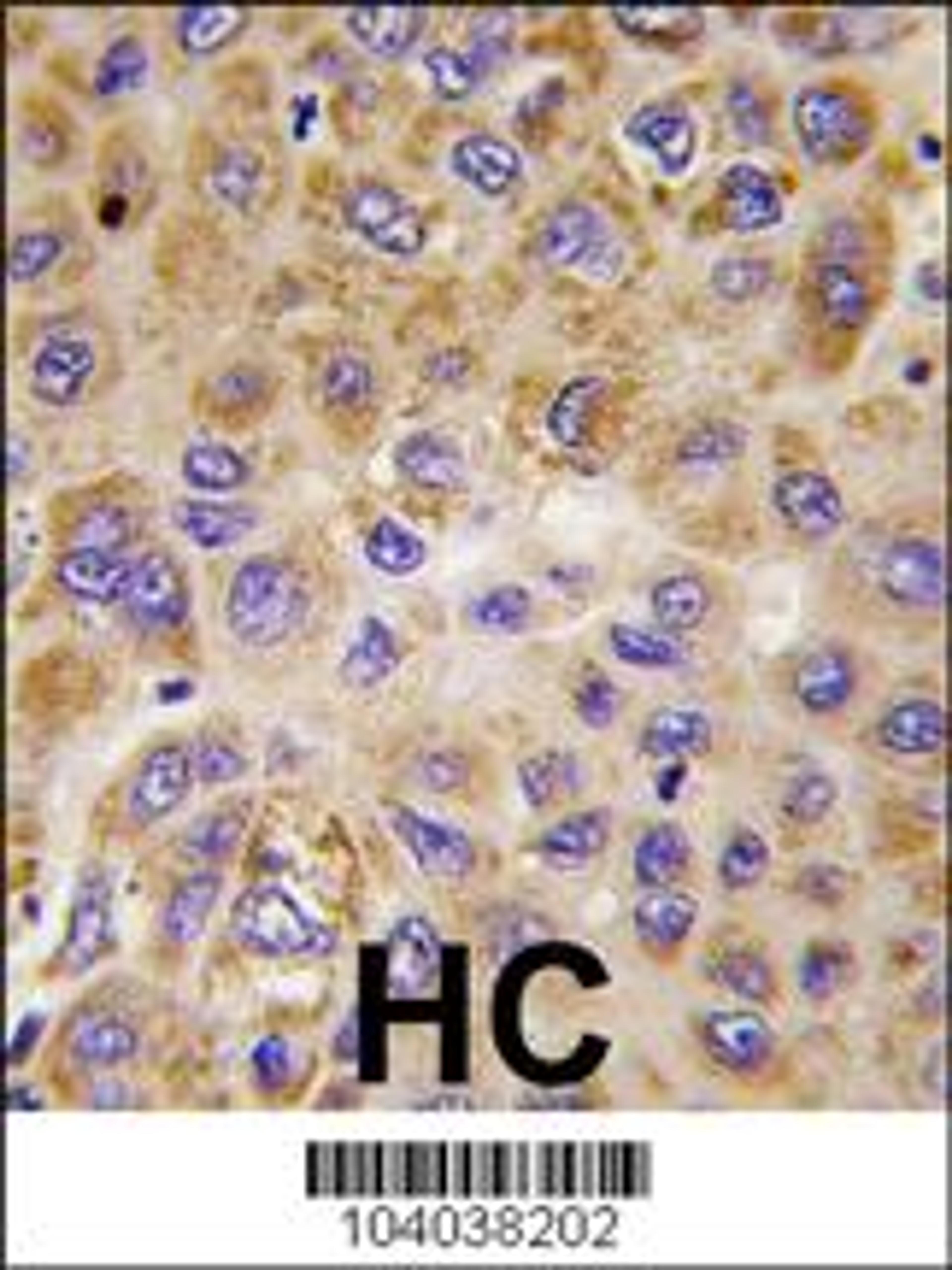 Formalin-fixed and paraffin-embedded human hepatocarcinoma tissue reacted with PFKFB1 antibody , which was peroxidase-conjugated to the secondary antibody, followed by DAB staining.