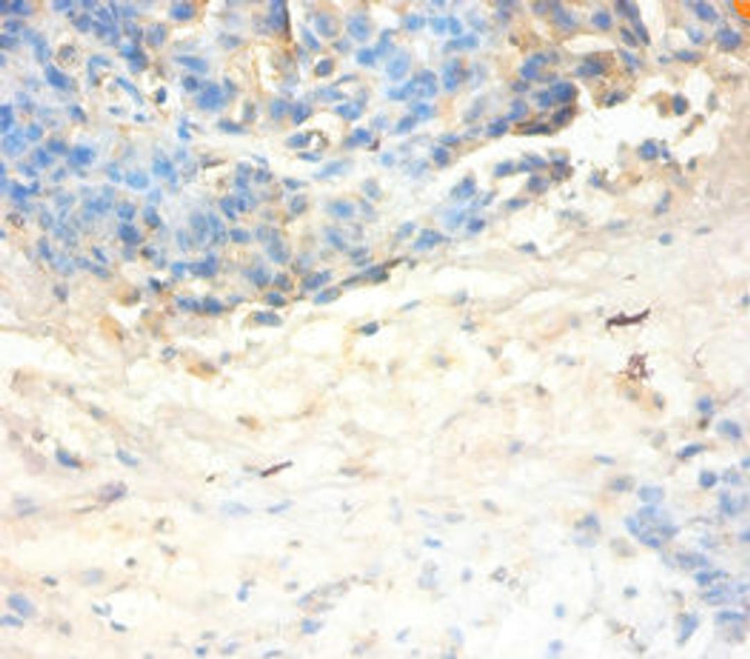 Immunohistochemistry of paraffin-embedded human ovarian cancer using CSB-PA07154A0Rb at dilution of 1:100