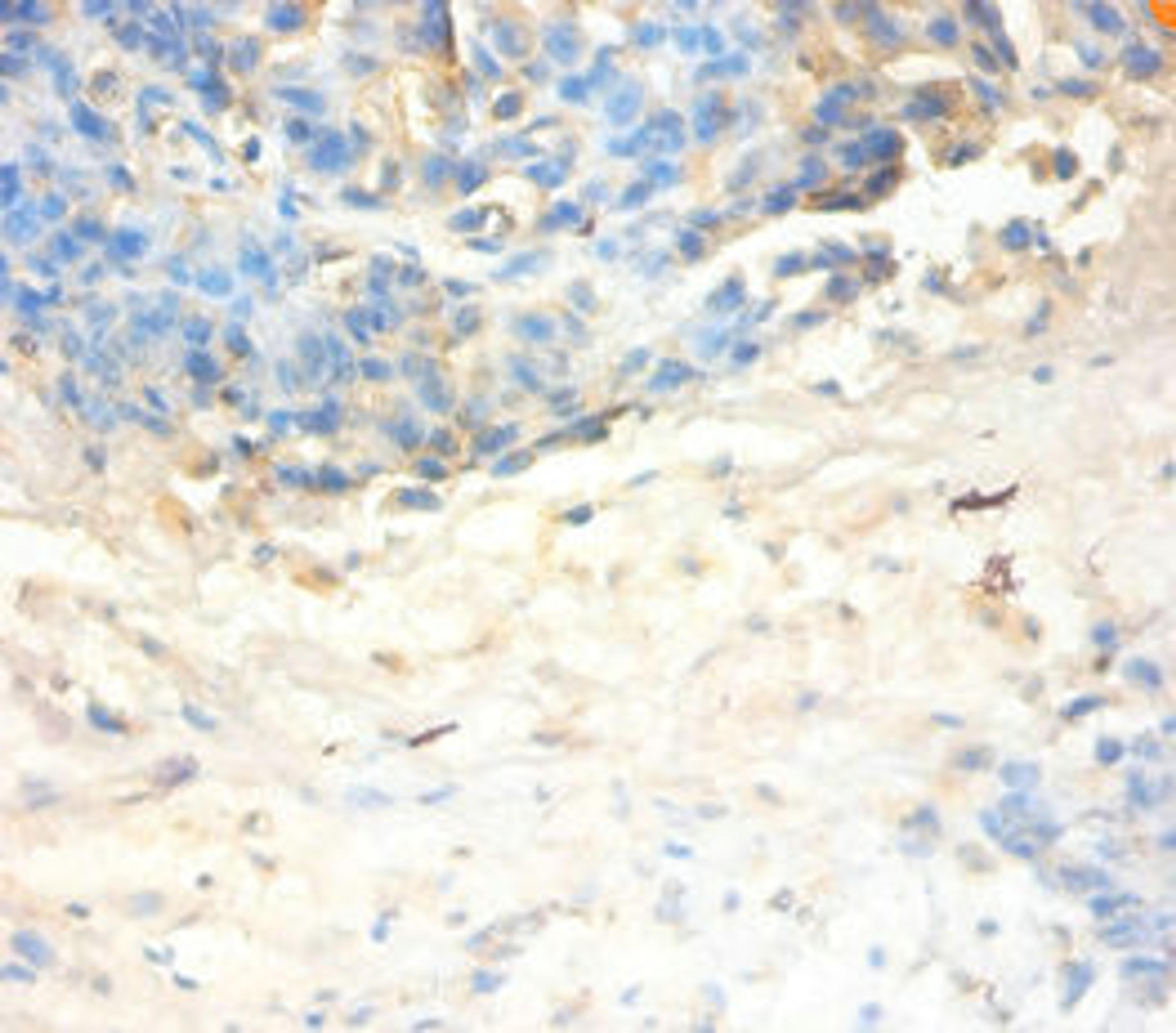 Immunohistochemistry of paraffin-embedded human ovarian cancer using CSB-PA07154A0Rb at dilution of 1:100