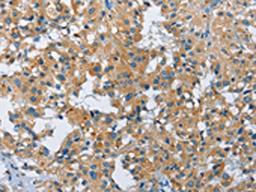 The image on the left is immunohistochemistry of paraffin-embedded Human thyroid cancer tissue using CSB-PA171435(FGF9 Antibody) at dilution 1/40, on the right is treated with fusion protein. (Original magnification: ×200)