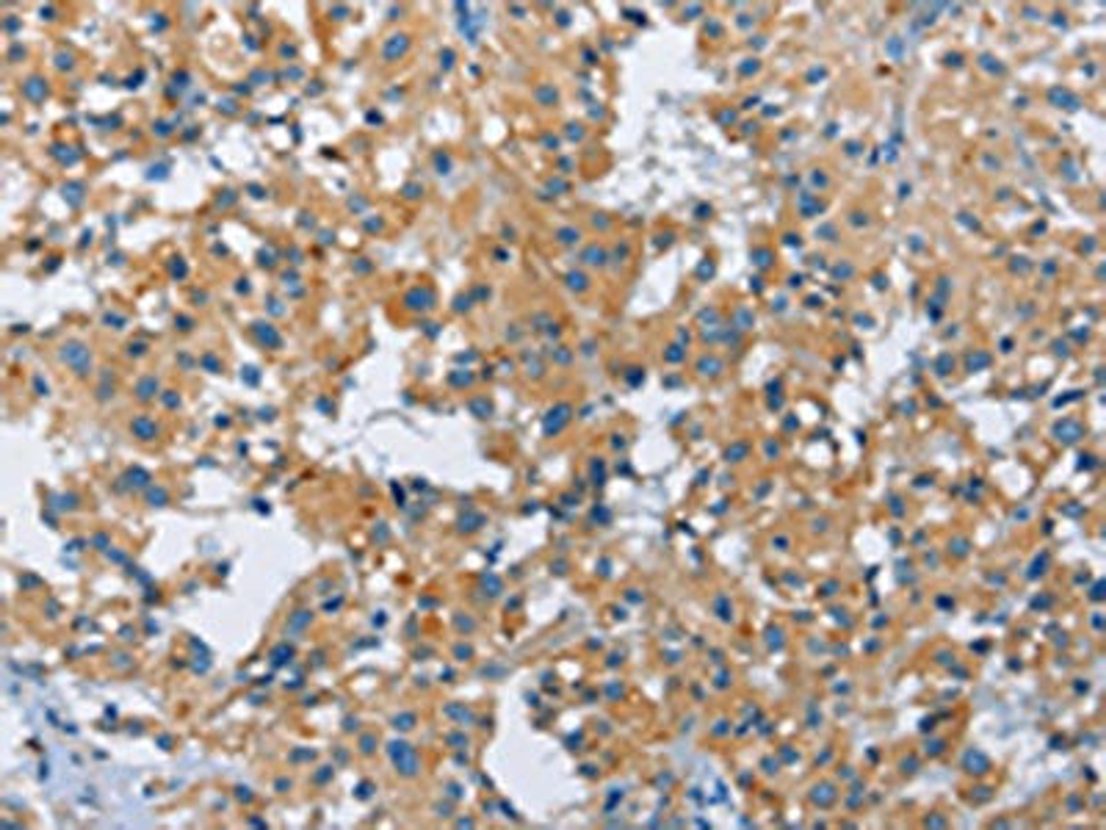 The image on the left is immunohistochemistry of paraffin-embedded Human thyroid cancer tissue using CSB-PA171435(FGF9 Antibody) at dilution 1/40, on the right is treated with fusion protein. (Original magnification: ×200)