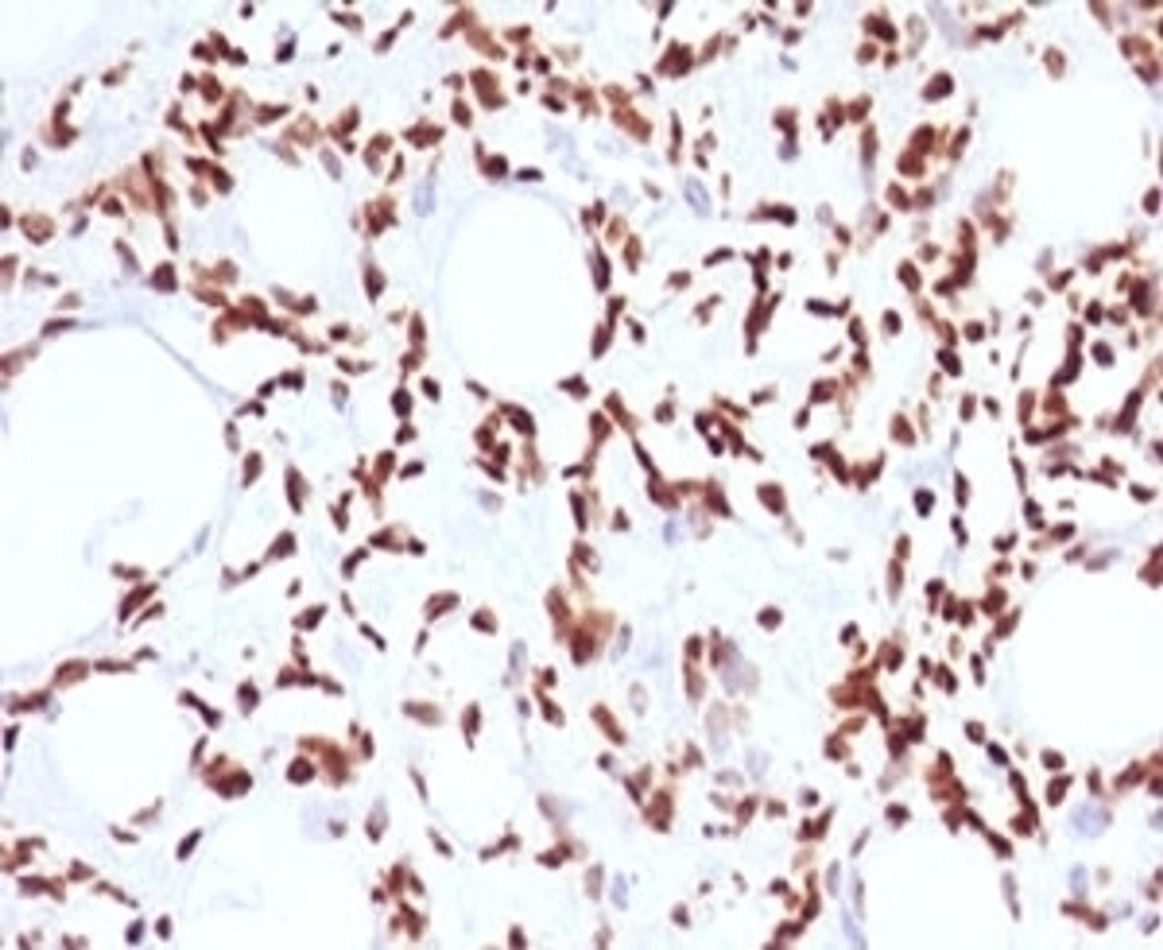 IHC testing of FFPE human angiosarcoma and Histone H1 antibody (clone OSHT-2).