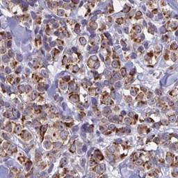 Immunohistochemistry: DOCK11 Antibody [NBP2-32488] - melanoma