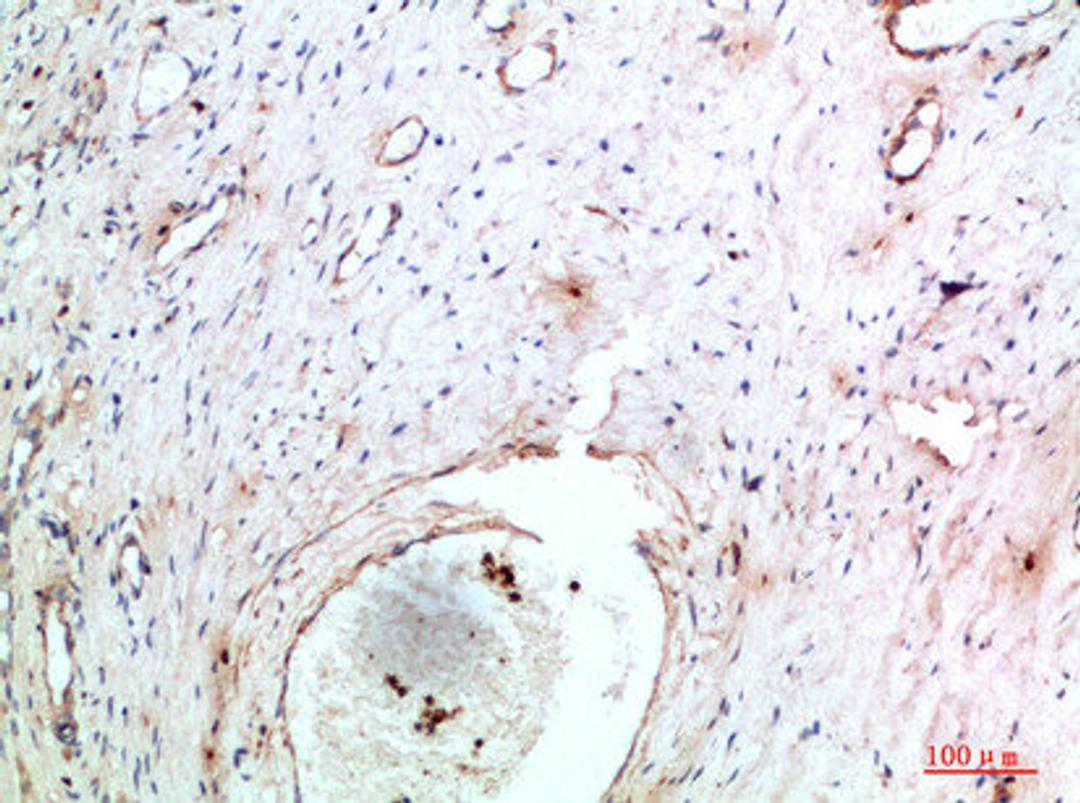 Immunohistochemical analysis of paraffin-embedded human-cervical-cancer, antibody was diluted at 1:200